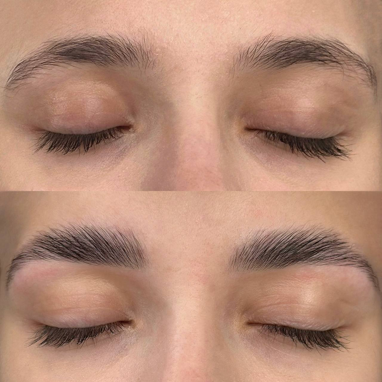 Ботокс бровей